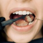 how to fix a chipped tooth at home