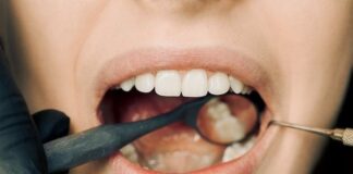 how to fix a chipped tooth at home