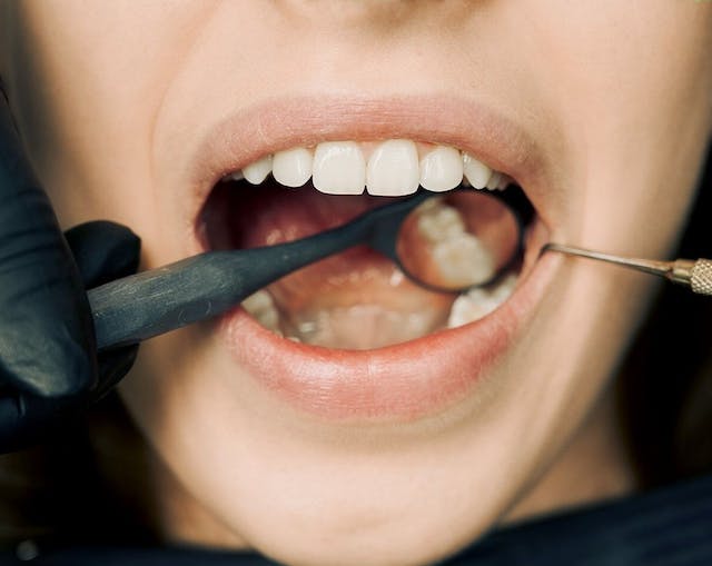 how to fix a chipped tooth at home